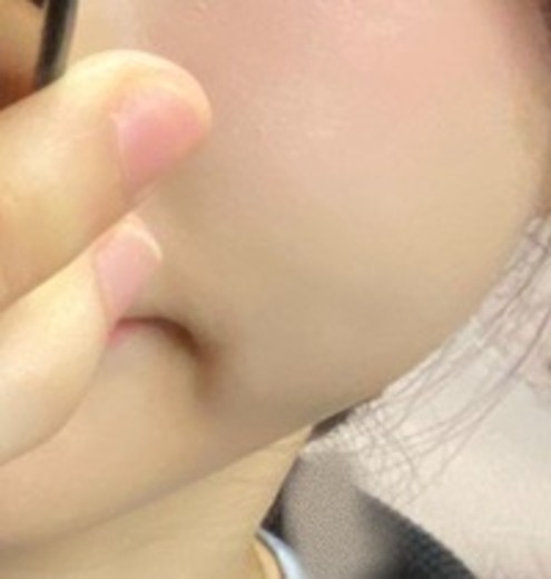 after photo: 튠페이스리프팅, 티타늄리프팅