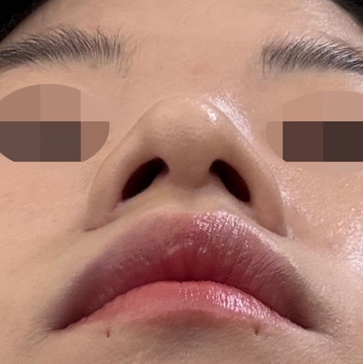 after photo: 콧볼축소