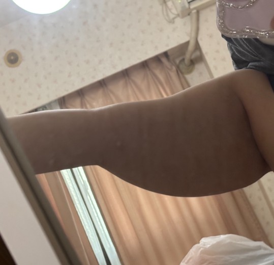 before photo: 脂肪冷却(背中)