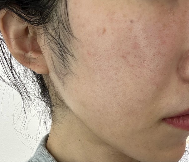 before photo: エレクトロポレーション