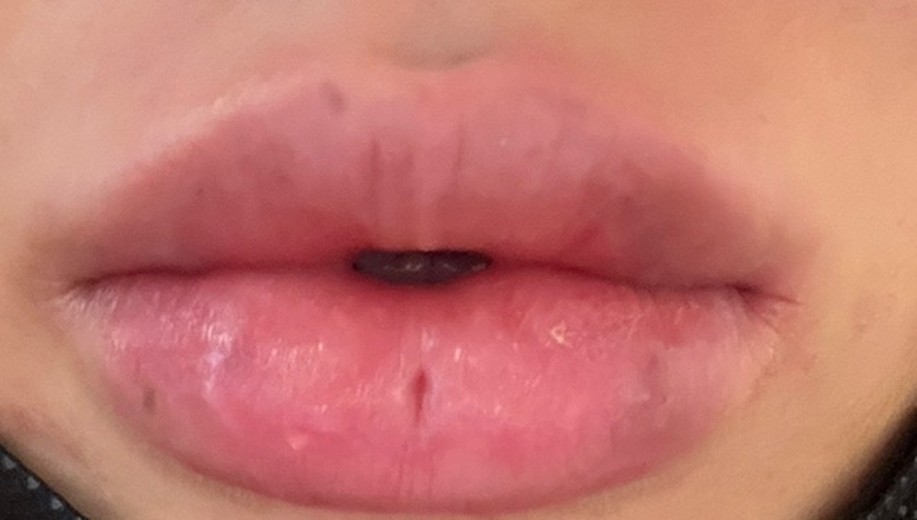 after photo: 필러제거주사