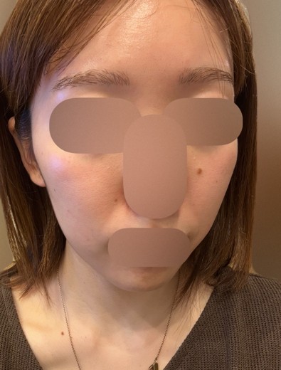 after photo: ルメッカ