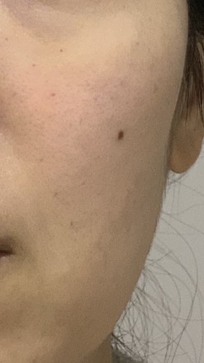 after photo: 스킨보톡스