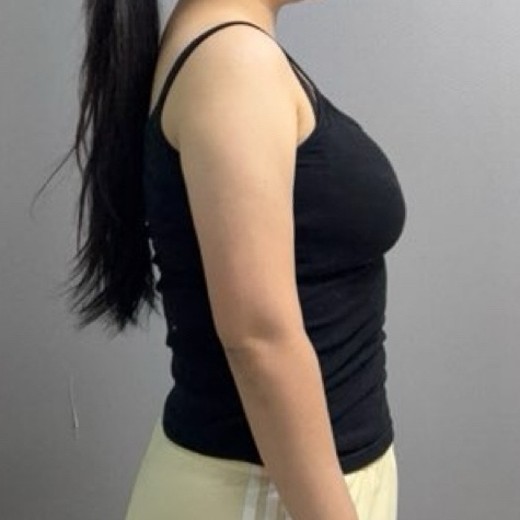 after photo: 脂肪溶解注射(腕)