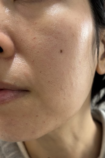 after photo: 스킨보톡스