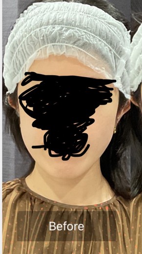 before photo: チタニウムリフト