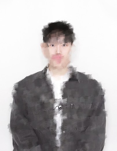 after photo: 콧대(보형물), 코끝(자가연골)