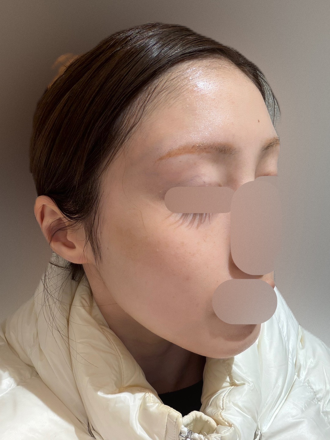 エレクトロポレーション（薬剤1剤付き）｜お顔から首までしっかりケア