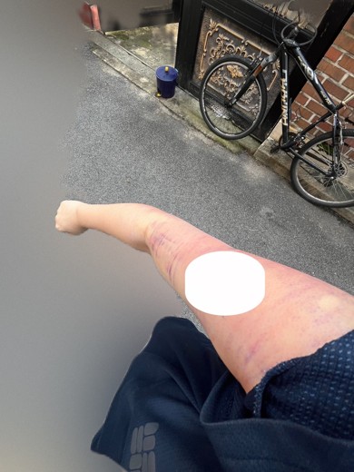 after photo: 팔지방흡입