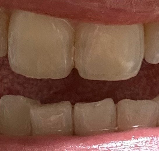 after photo: ホワイトニング