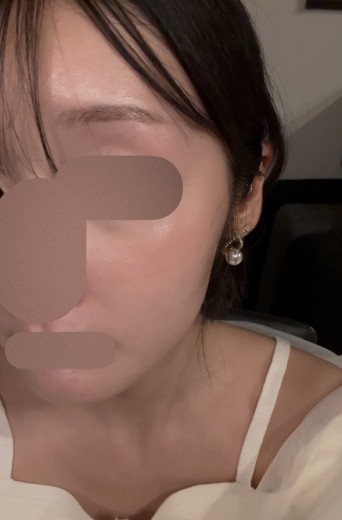before photo: ピーリング