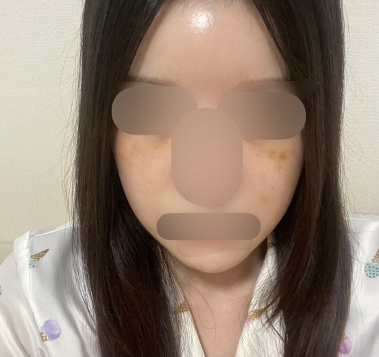 after photo: リジュランヒーラー, スキンボトックス