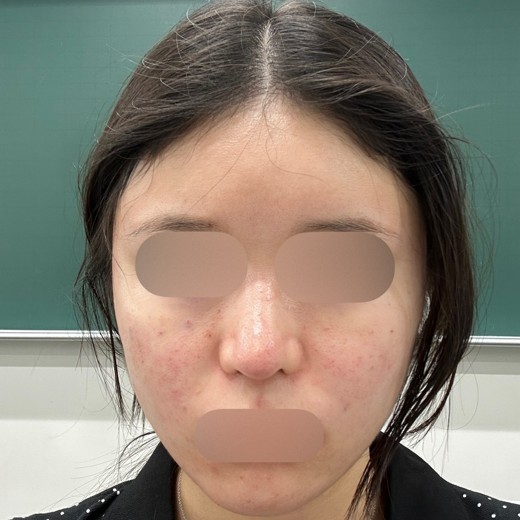 after photo: ジュベルック(Juvelook)