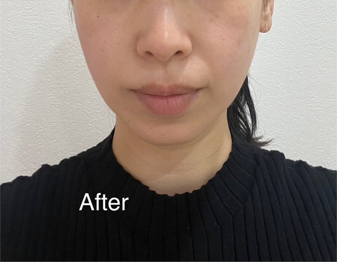 after photo: チタニウムリフト