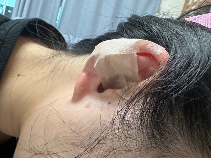 after photo: 캘로이드귀성형