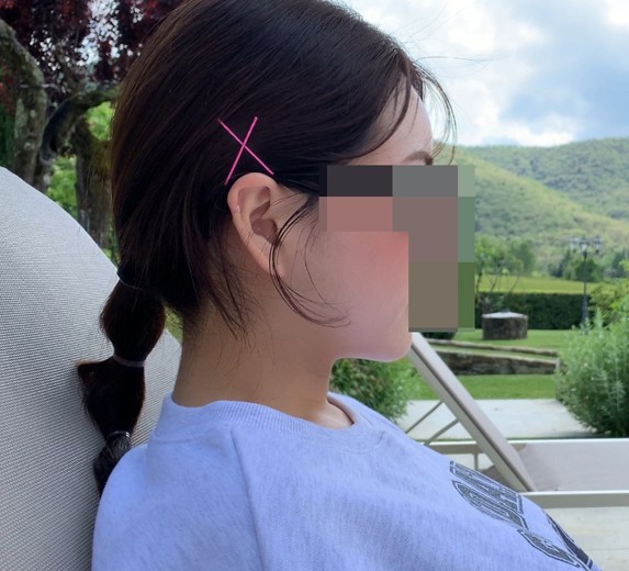 after photo: 이마필러