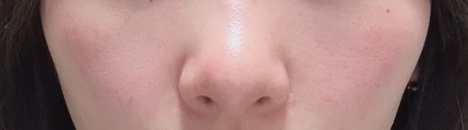 after photo: 脂肪溶解注射(顔)