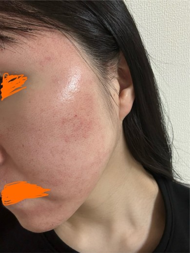 after photo: ダーマペン