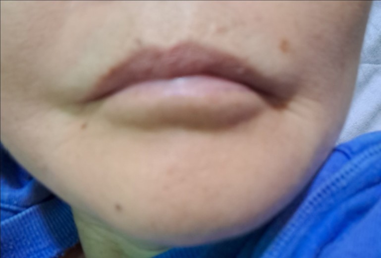 after photo: 윤곽주사, 얼굴지방분해주사