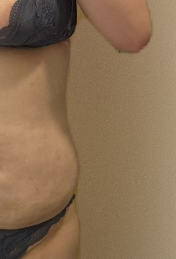 after photo: 脂肪溶解注射(腹部)
