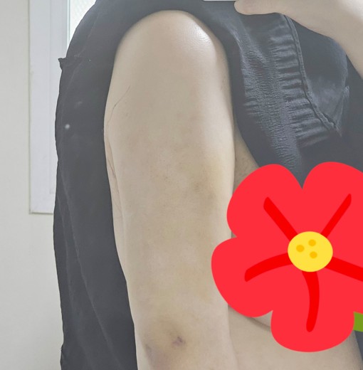 after photo: 러브핸들지방흡입, 복부지방흡입