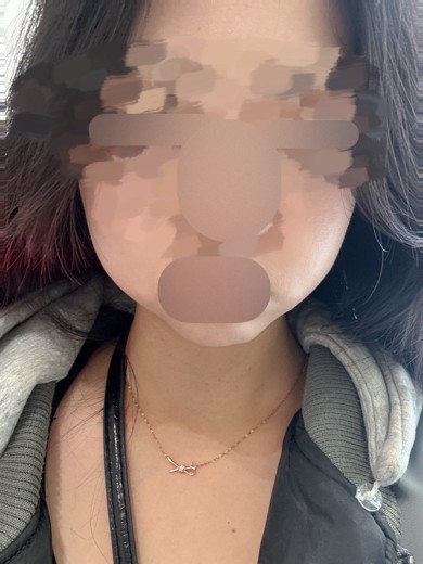 after photo: 온다리프팅