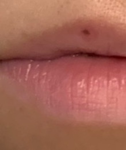after photo: IPL(光/フォト治療), ルメッカ