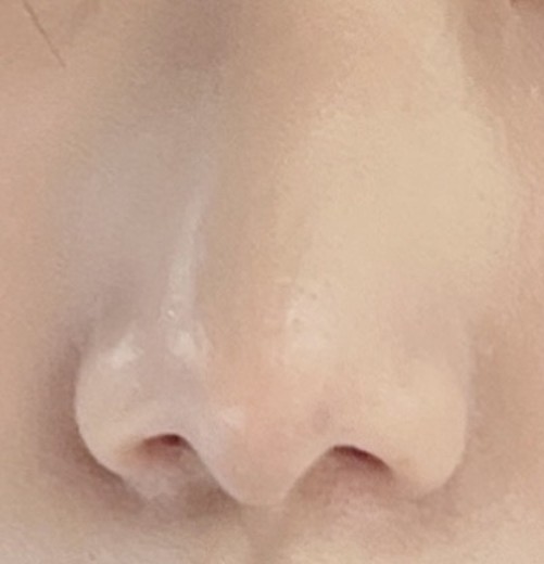 after photo: 콧볼축소