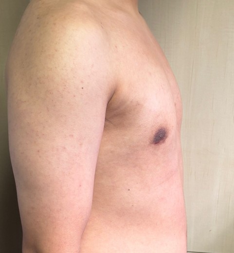 after photo: 여유증수술