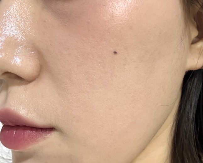 after photo: 리쥬란힐러