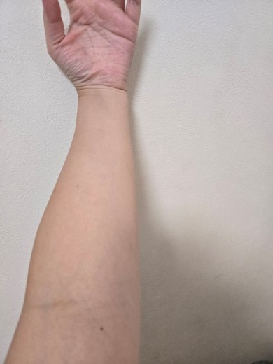 after photo: 白玉注射・点滴, 美容注射・点滴