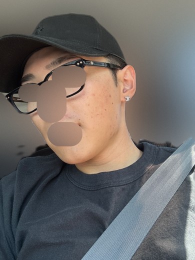 after photo: IPL(光/フォト治療)