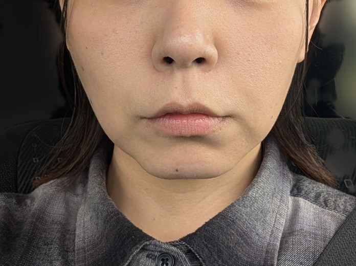 after photo: ハイフ(HIFU)