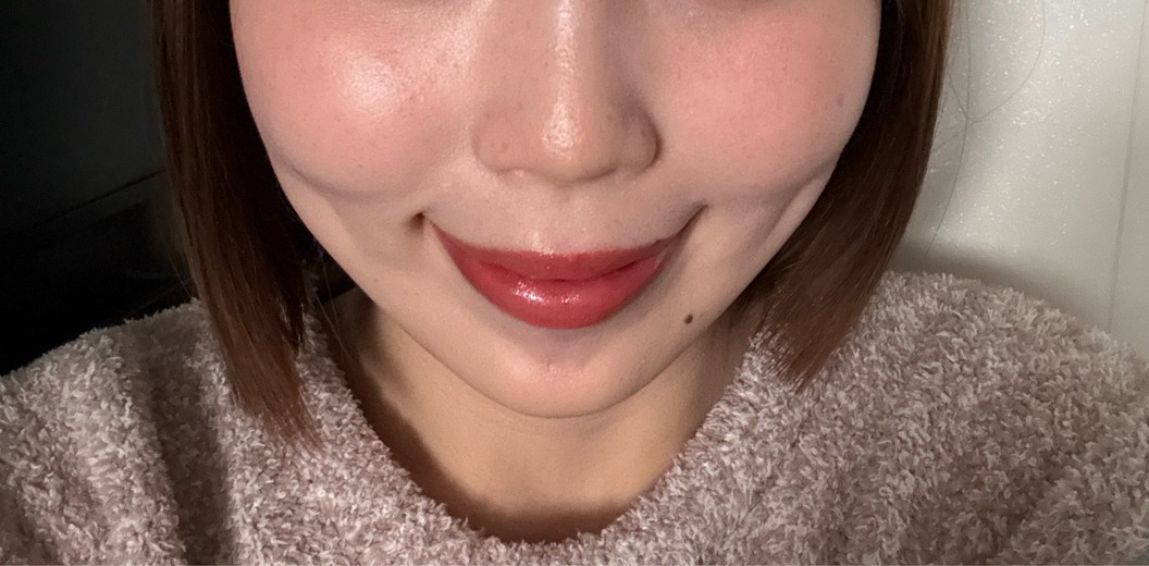 after photo: 脂肪溶解注射(顔)