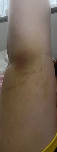 after photo: 脂肪吸引(腕)