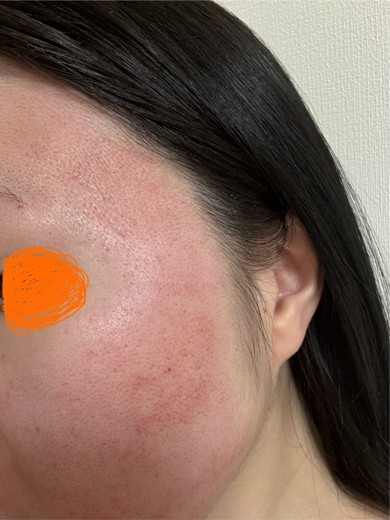 after photo: ダーマペン