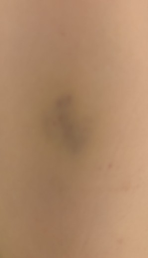 after photo: 脂肪冷却(腕)