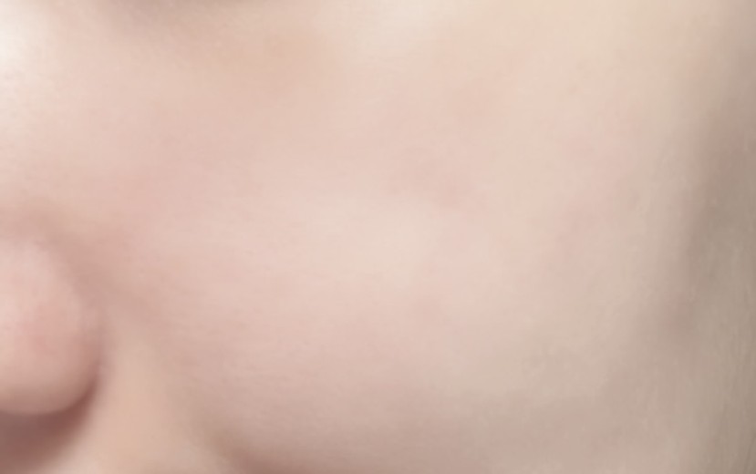 after photo: 아쿠아필링