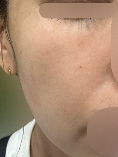 before photo: エレクトロポレーション