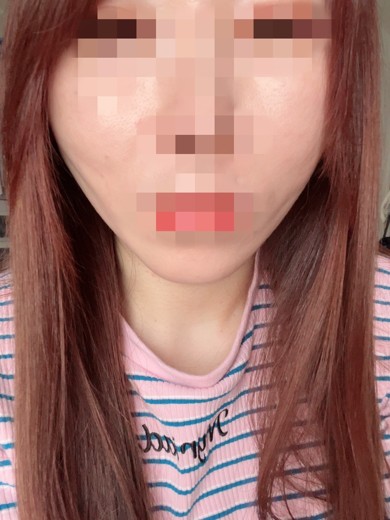 after photo: 糸リフト