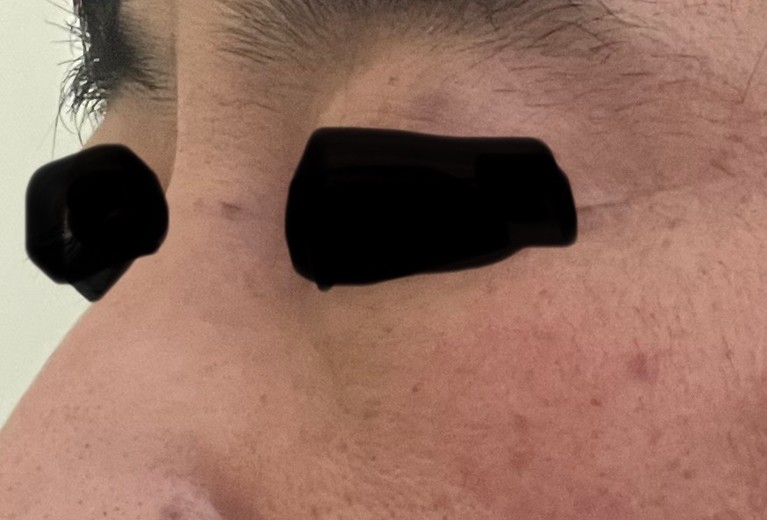 after photo: サーモン注射
