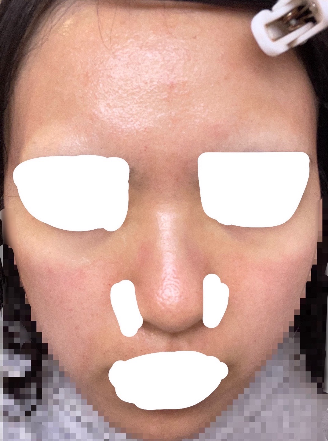 再来OK】ヴェルベットスキン 全顔 | MINIMUM SKIN CLINIC