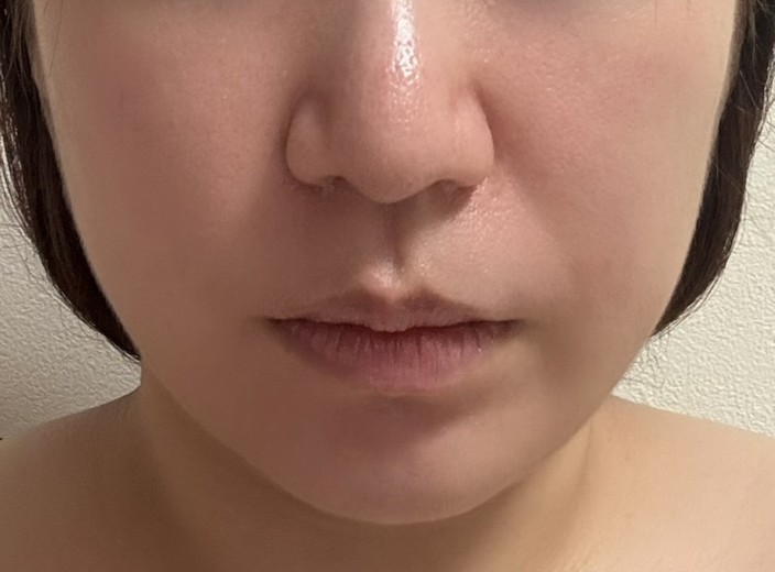 after photo: リニアファーム(ハイフ)