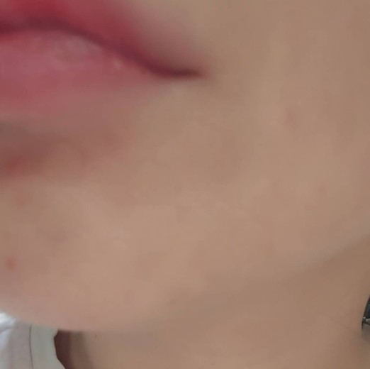 after photo: 여드름주사