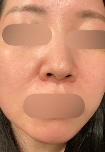 after photo: ルメッカ