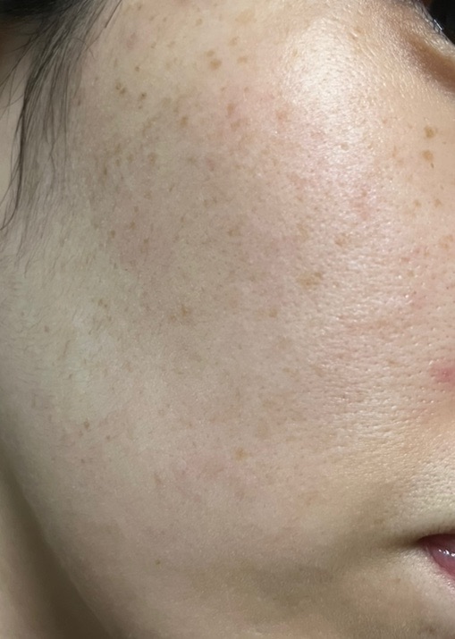 IPL（光治療）全顔2周 ｜ステラM22フォトフェイシャル【12月29日迄にご