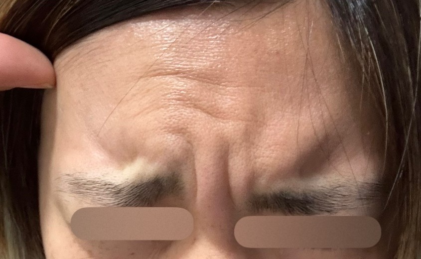 before photo: スキンボトックス, 額のしわボトックス