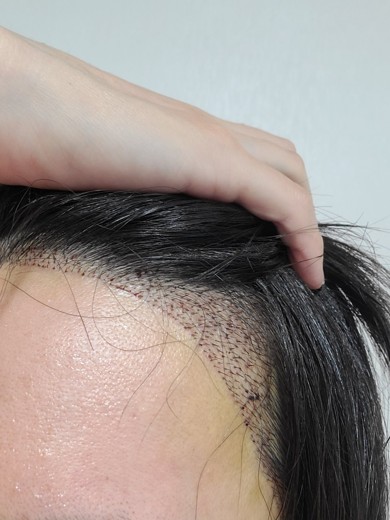 after photo: 머리모발이식