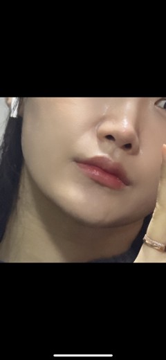 after photo: 팔자주름필러