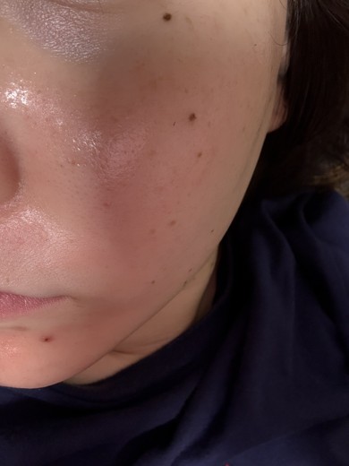 after photo: ダーマペン